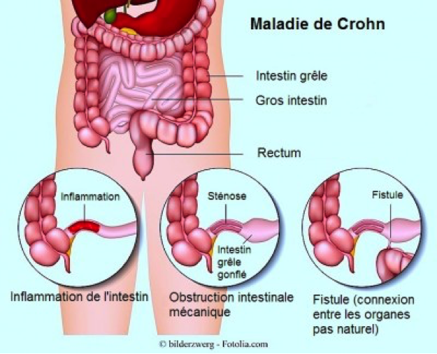 Schéma des effets de la maladie de Crohn dans le corps humaine