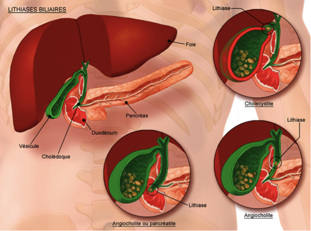 La vésicule biliaire est un petit organe creux en forme de poire